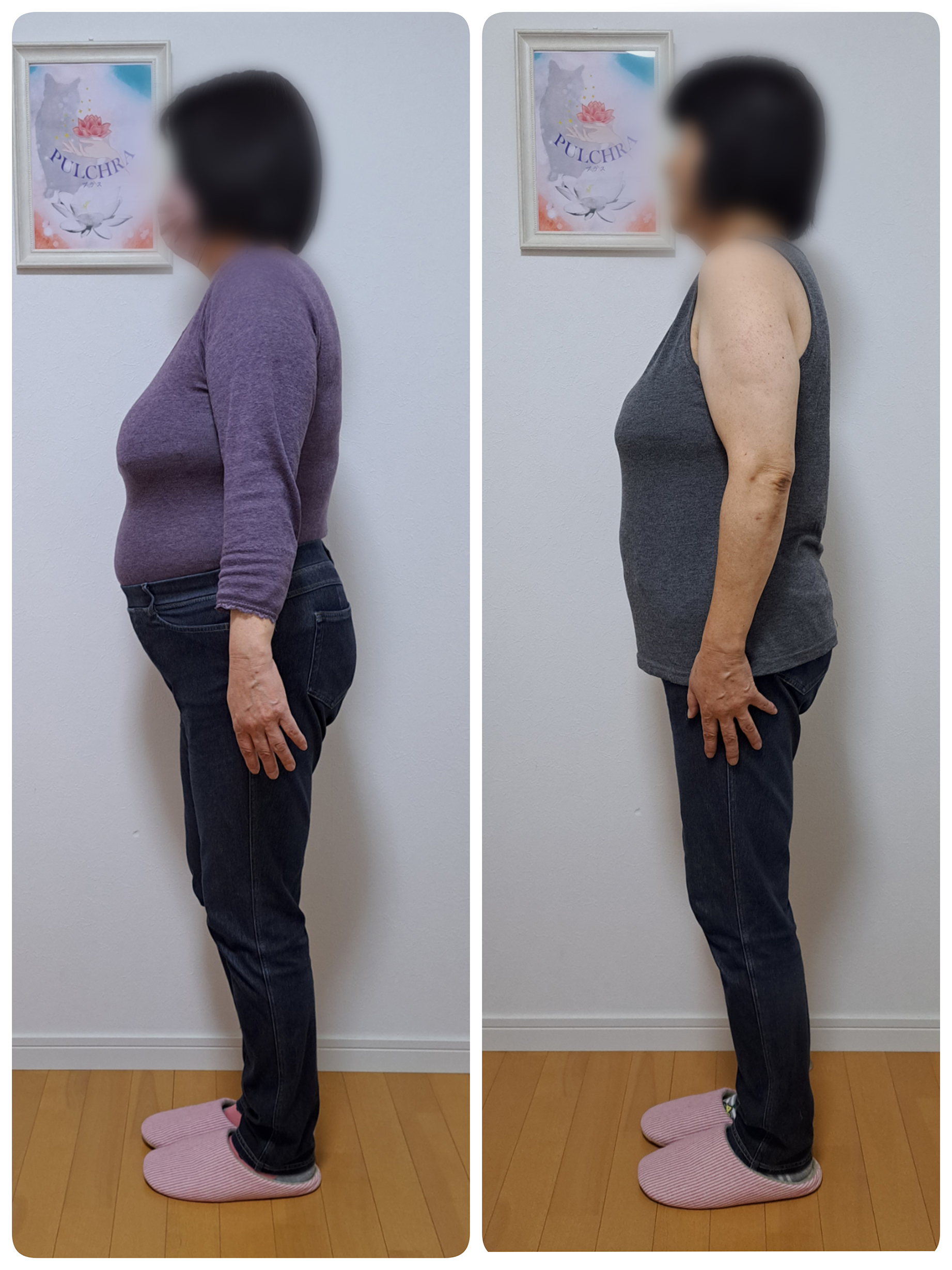 耳つぼダイエットの施術 | Before After