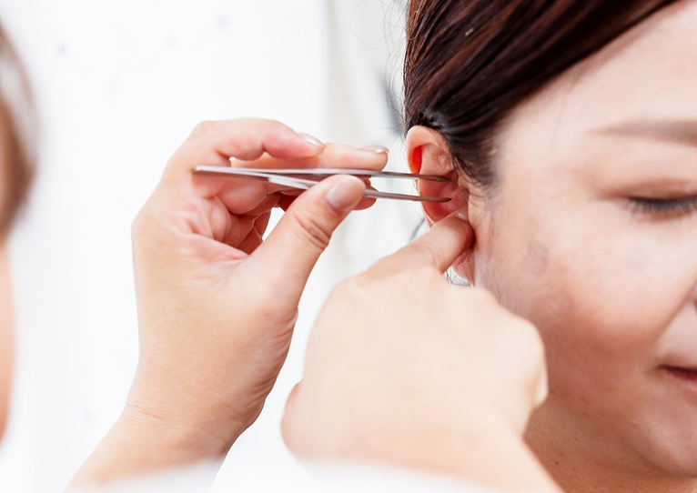 耳つぼダイエットの施術を受ける女性